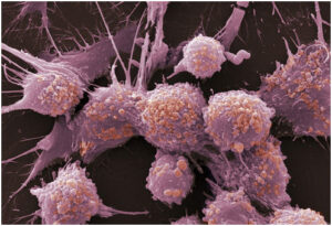 perkembangan sel kanker