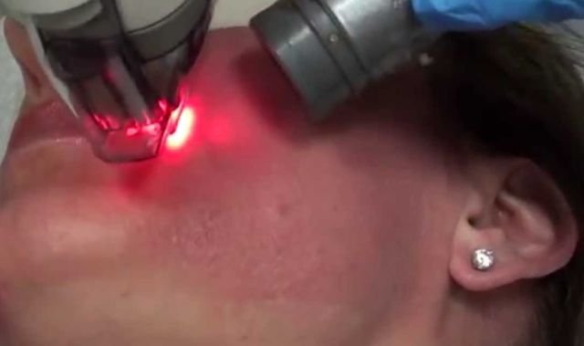 Terapi Laser Membuat Wajah Terlihat Lebih Muda